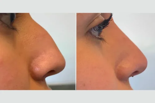 فیلر بینی و هر آنچه پیش از تزریق باید بدانید